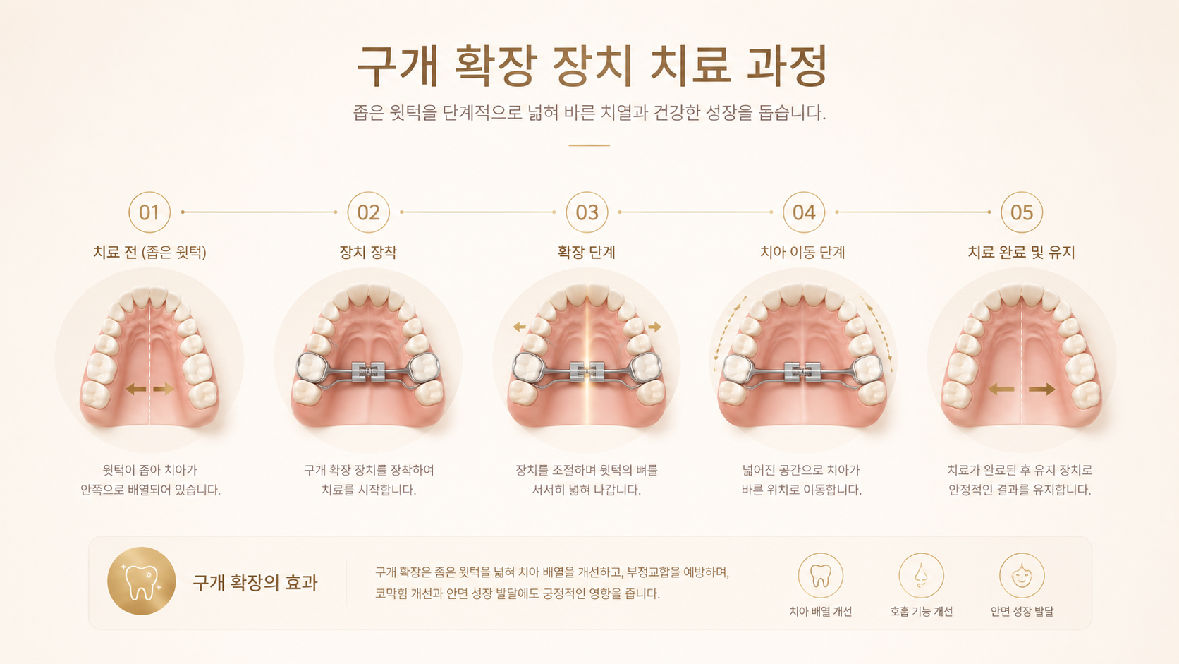 입천장 확장장치 가동에 따른 초기 미세 이완, 2주 차 대문니 공간 확보, 4주 차 이후 치열의 가역적 모임 양상을 깨끗한 가로형 흐름선으로 표현한 메디컬 3D 그래픽 인포그래픽