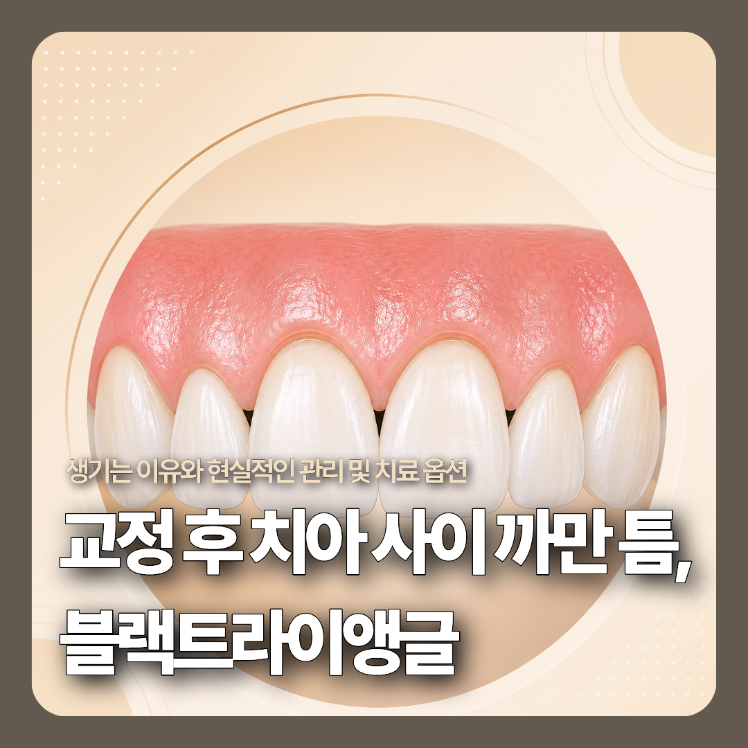 치아교정 후 치아 사이사이에 나타나는 삼각형 모양의 빈 공간(블랙트라이앵글)의 해부학적 발생 원인을 보여주는 3D 메디컬 일러스트