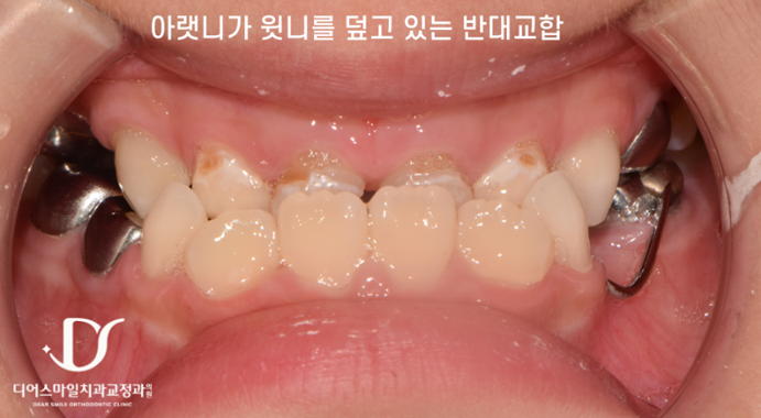 인천송도교정치과 어린이 반대교합 페이스마스크 교정 전