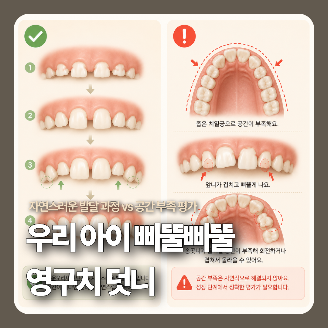 어린이 혼합치열기 앞니 맹출 과정의 자연스러운 발달 단계와 실제 턱 뼈 공간 부족으로 치아가 겹치는 상태를 대조해 보여주는 2분할 3D 메디컬 일러스트