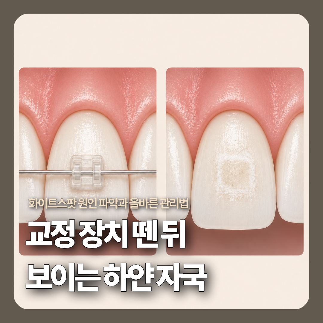 브라켓 주변이 깨끗하게 유지된 정상 치아와 브라켓 잇몸 쪽 경계를 따라 둔탁한 흰색 띠가 관찰되는 치아를 대비하여 보여주는 정면 2분할 3D 메디컬 일러스트