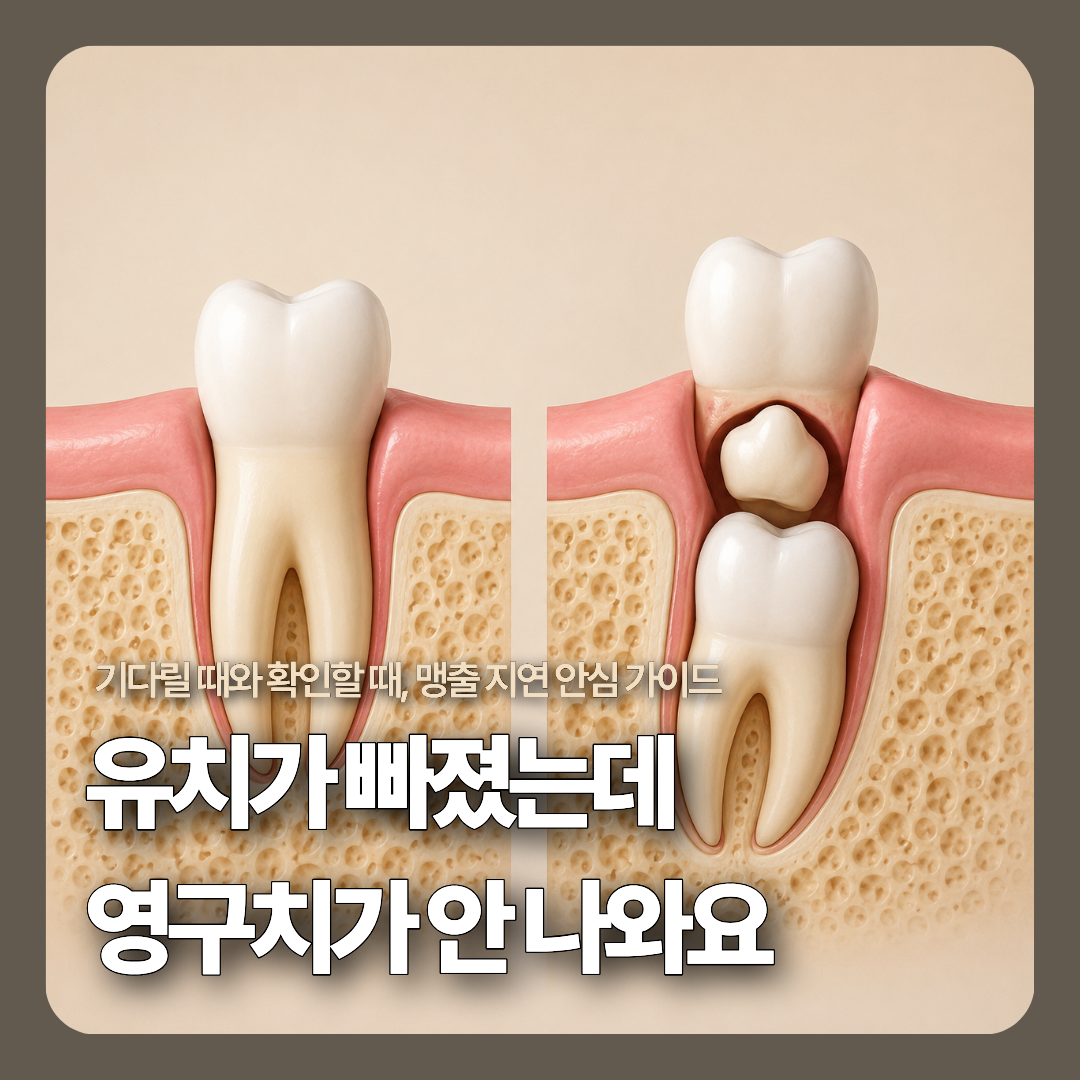 정상적으로 잇몸을 뚫고 나오는 영구치와 과잉치로 인해 잇몸뼈 속에서 길목이 막힌 맹출 지연 영구치의 단순화된 3D 비교 단면 모식도