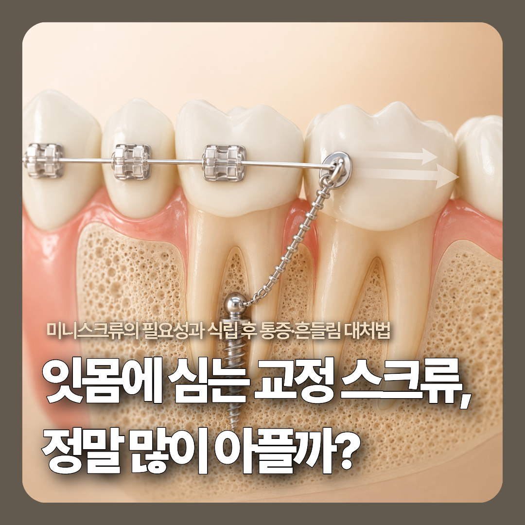치조골 잇몸 뼈 사이에 정교하게 위치하여 앞니나 전체 치열을 효율적으로 당겨주는 교정용 미니스크류의 고정원 역할을 나타낸 3D 메디컬 일러스트