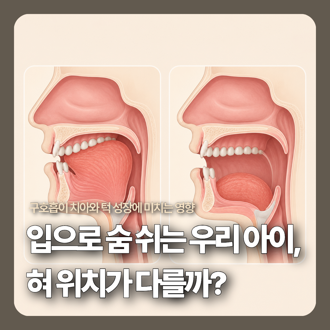 코로 숨 쉴 때 입천장에 올바르게 붙는 혀 위치와 입으로 숨 쉴 때 아래로 처지는 혀 위치만을 단순하고 명확하게 비교한 2분할 3D 의료 모식도