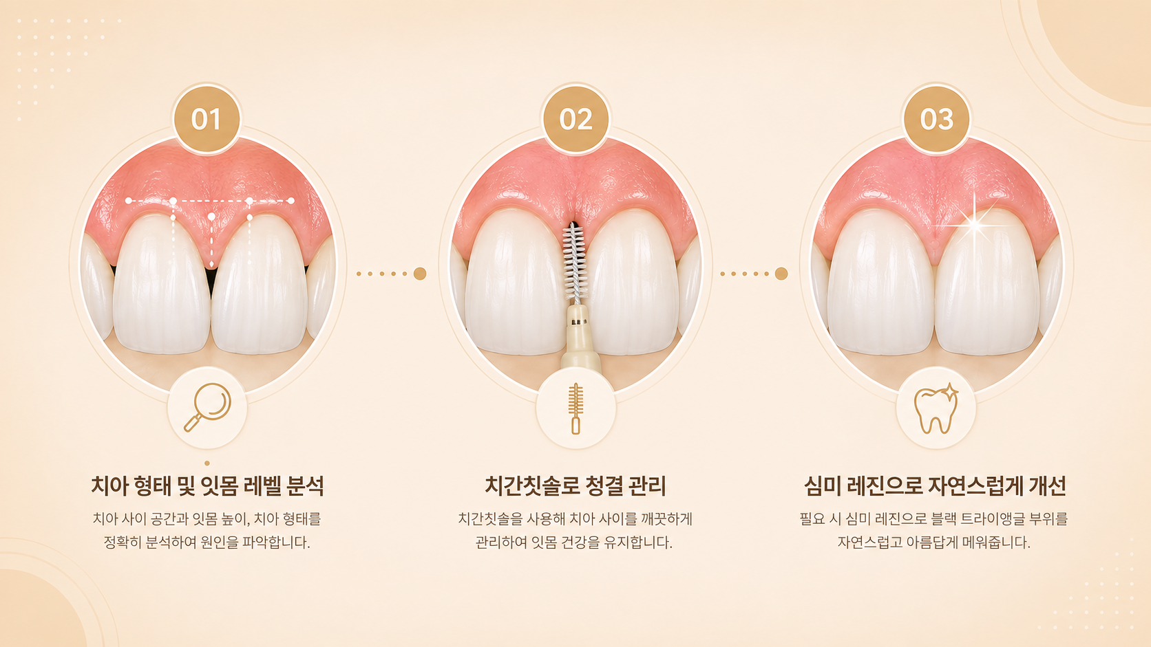 블랙트라이앵글 발생 원인 확인부터 구강 위생 관리, 개별 상태에 따른 IPR이나 레진 치료 선택 과정을 보여주는 안심 인포그래픽
