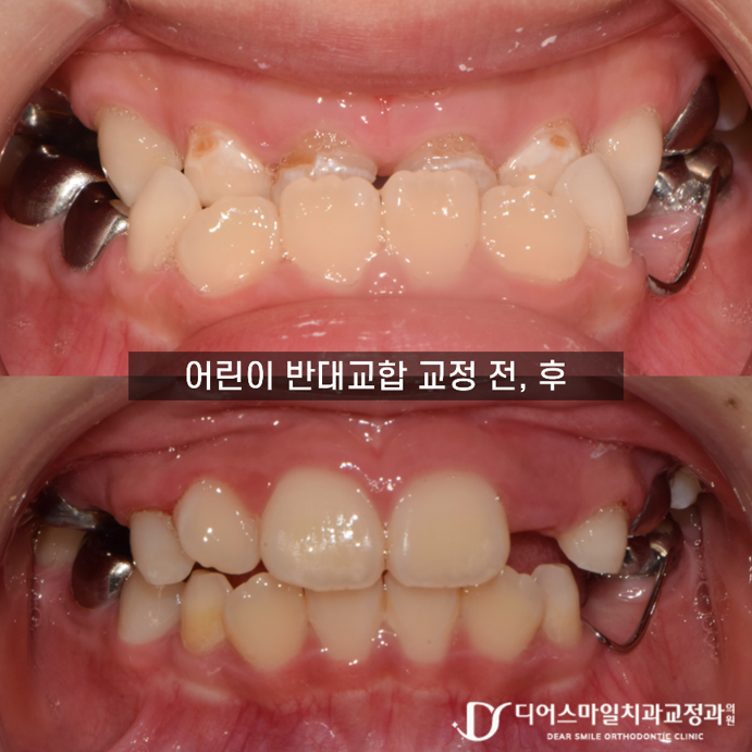 악궁확장·페이스마스크 치료 전후 변화