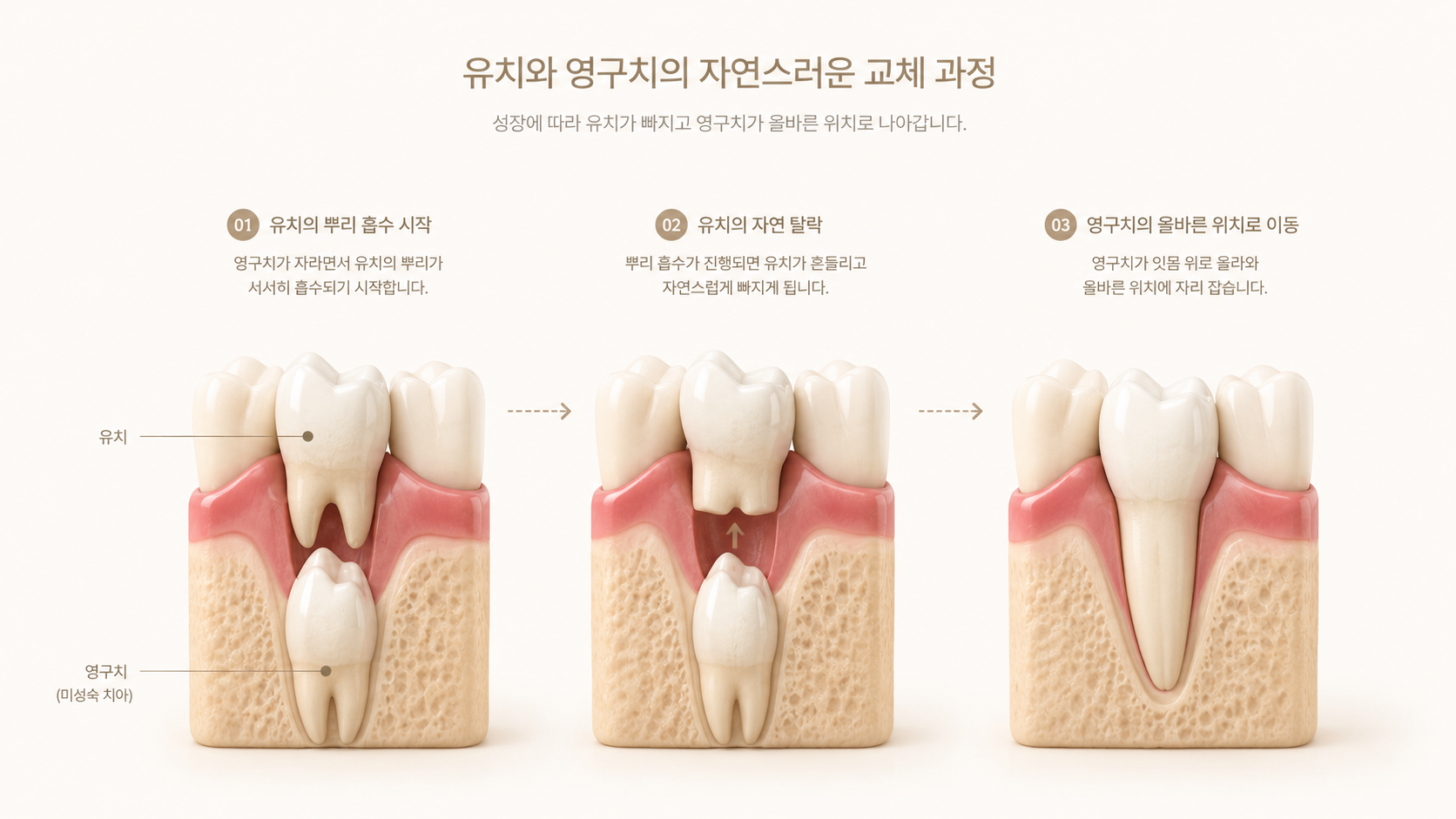 유치가 존재할 때 안쪽에 위치한 영구치와 유치 발치 후 혀의 자연스러운 밀림 힘에 의해 영구치가 전방 치열선으로 이동하는 과정을 나타낸 깨끗한 메디컬 3D 그래픽 인포그래픽