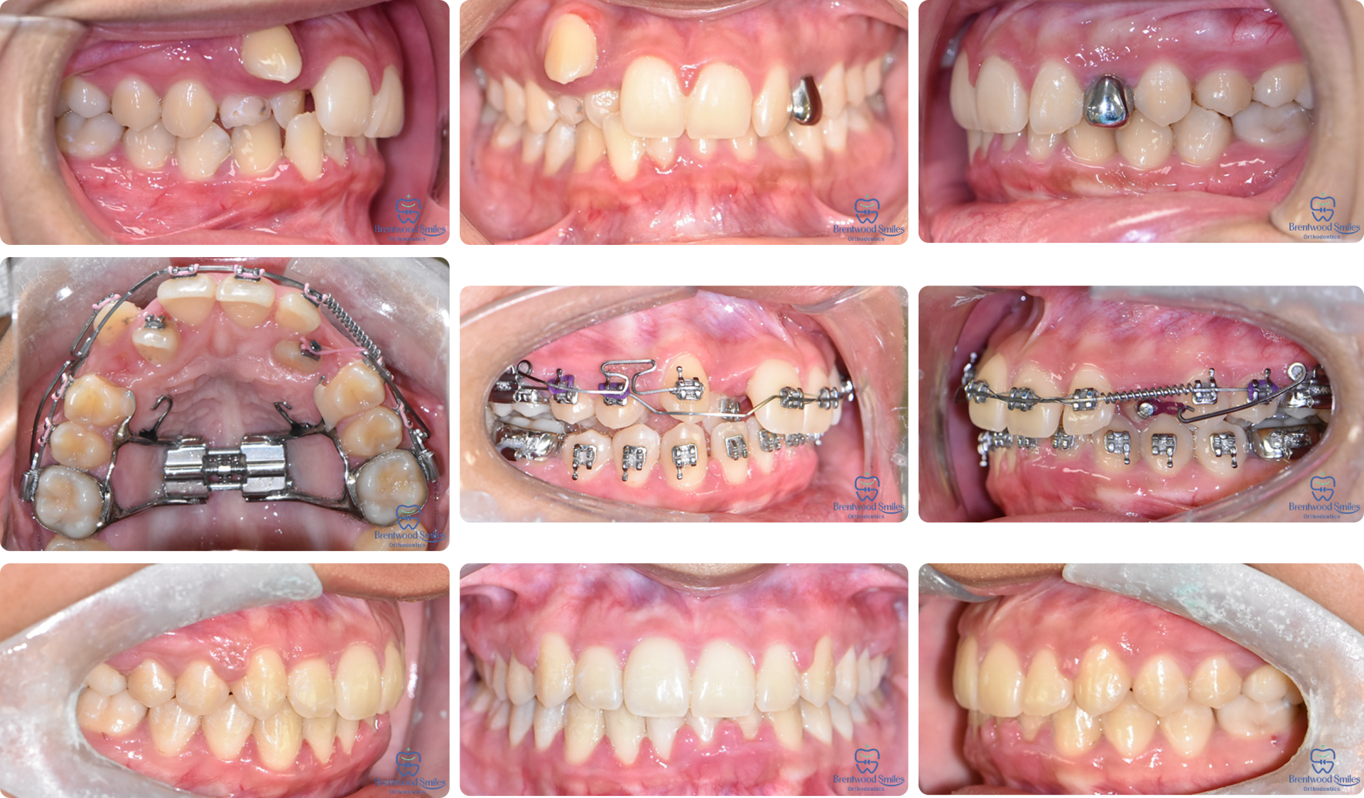 Case 13