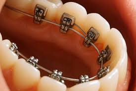 Lingual Braces