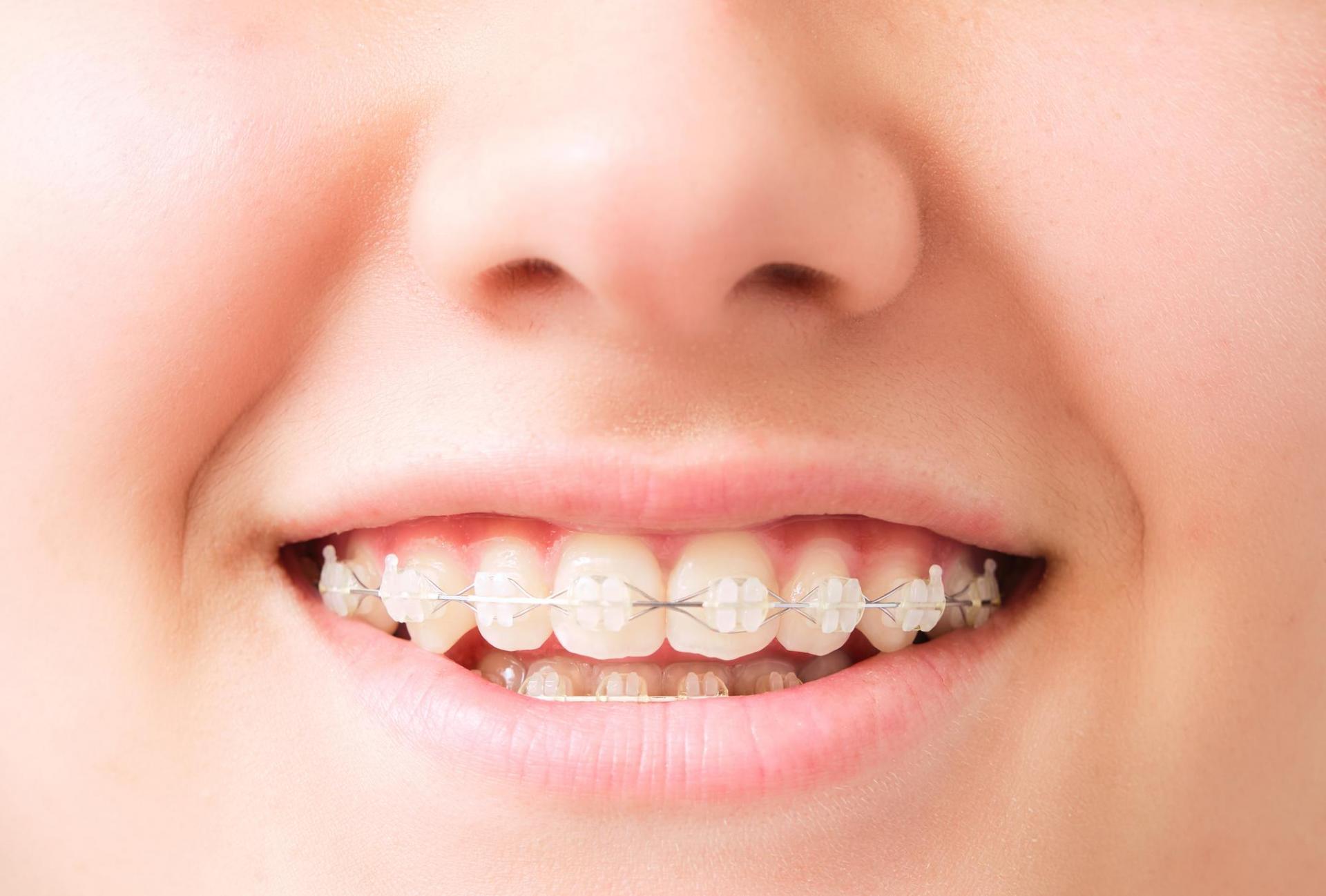 Ceramic Braces