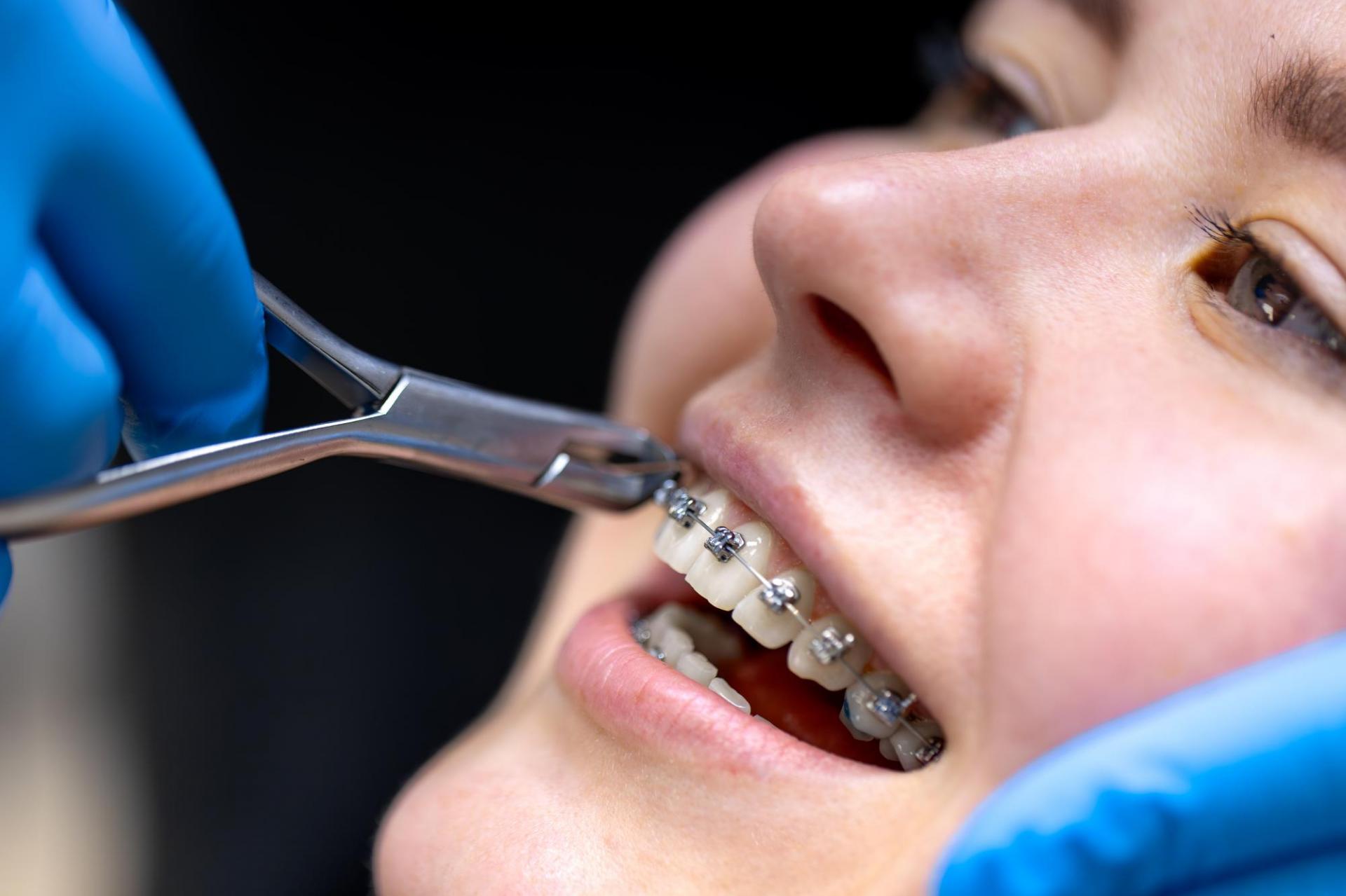 Traditional Metal Braces
