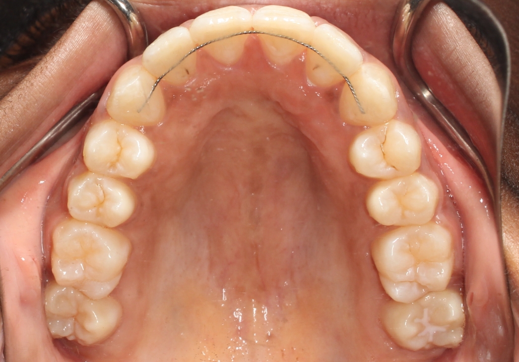 Fixed Retainer