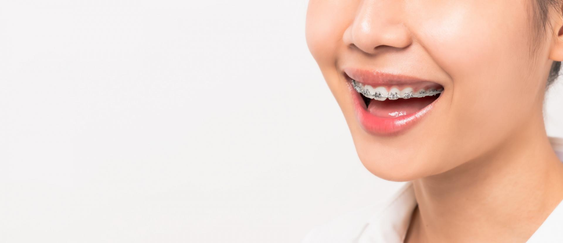 Braces Hero