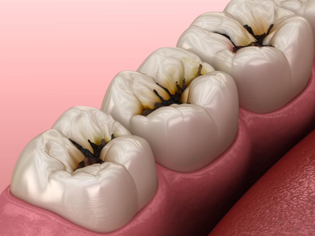 Tooth Wear and Decay