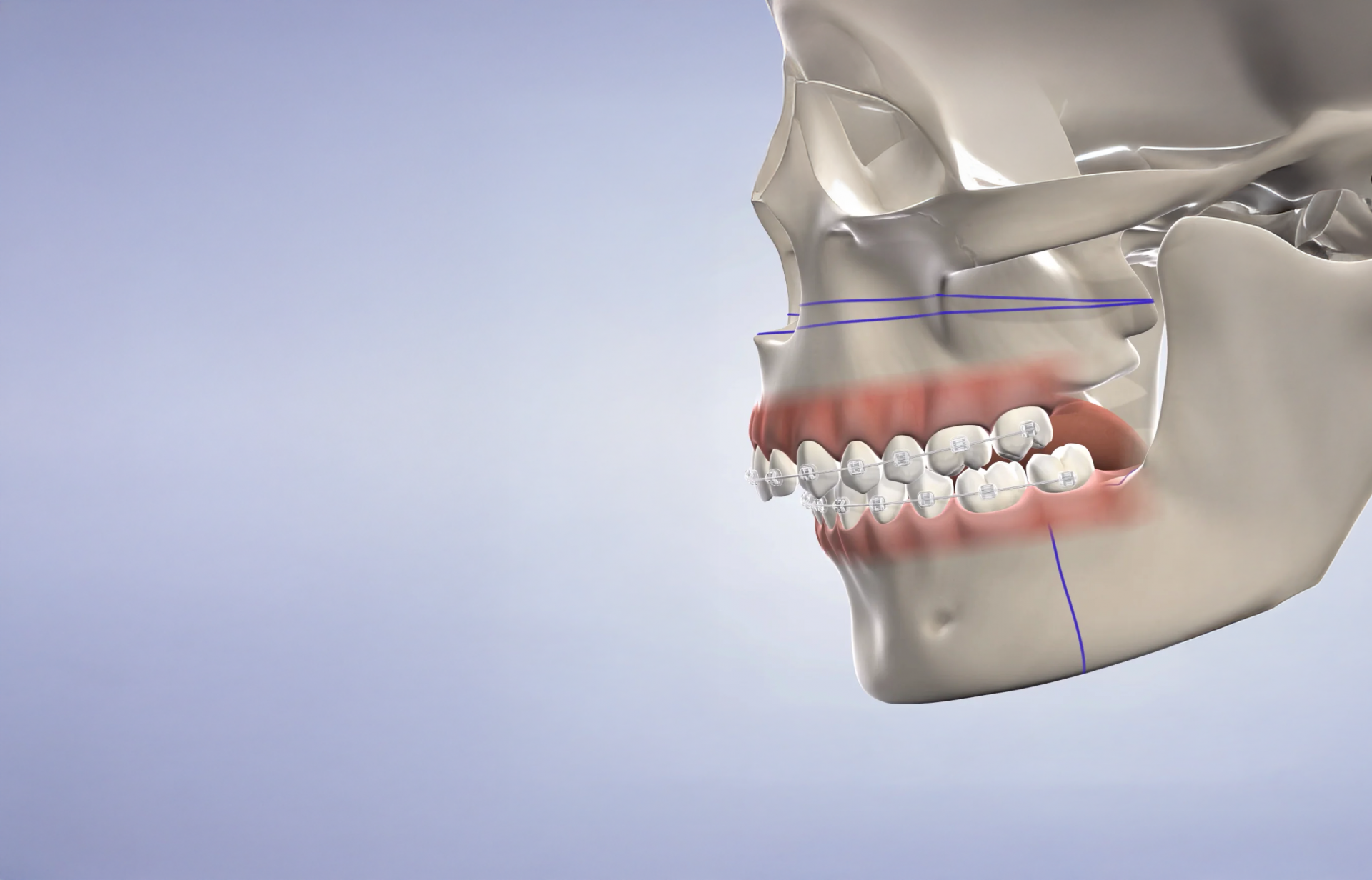 Orthodontic Surgery Hero