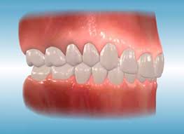 Overbite