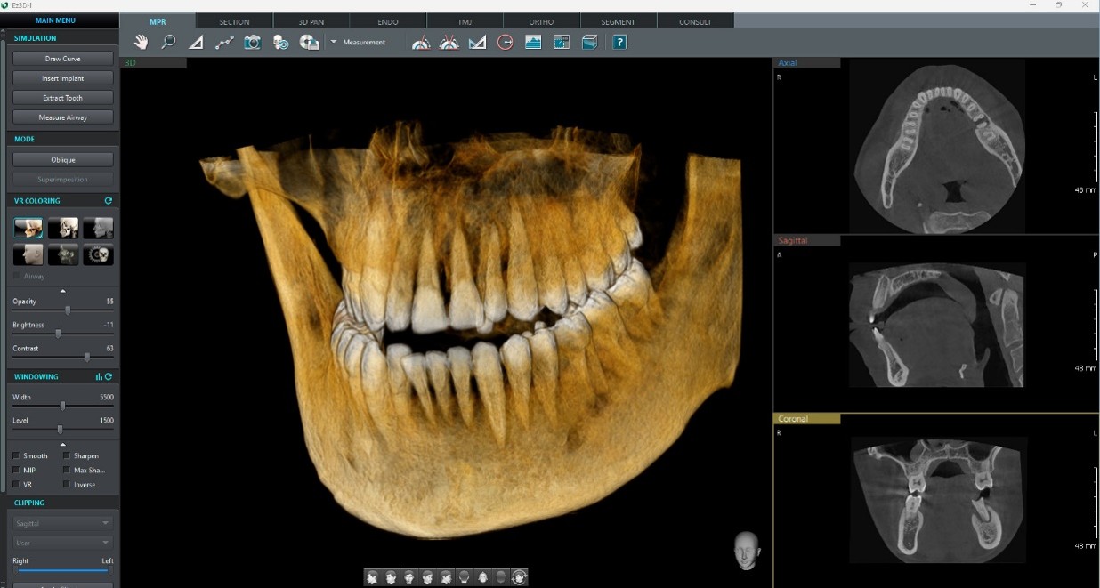 CBCT Scan