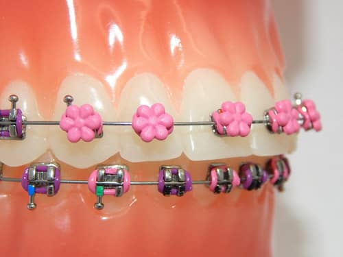 Designer Braces