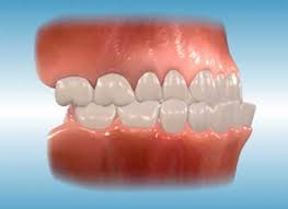 Underbite