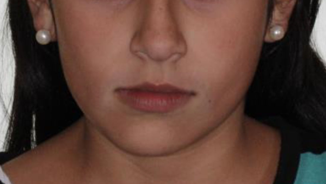 Facial Imbalance