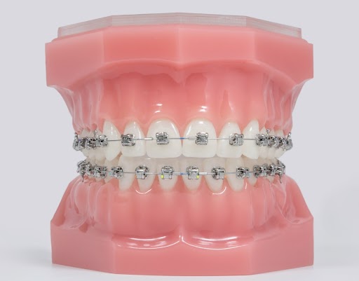 Self-Ligating Braces