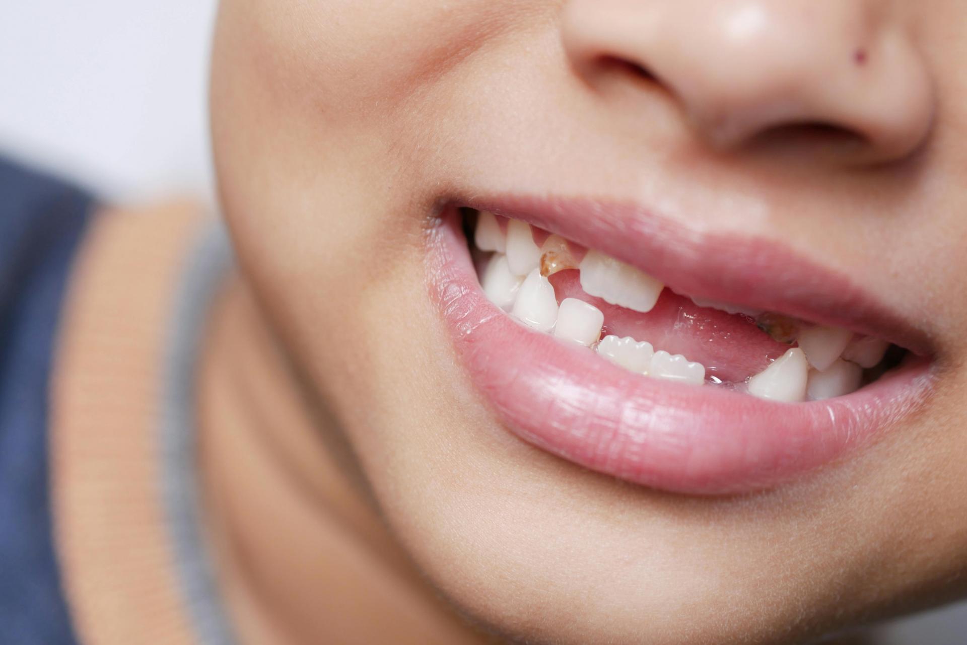 Early or Late Loss of Baby Teeth