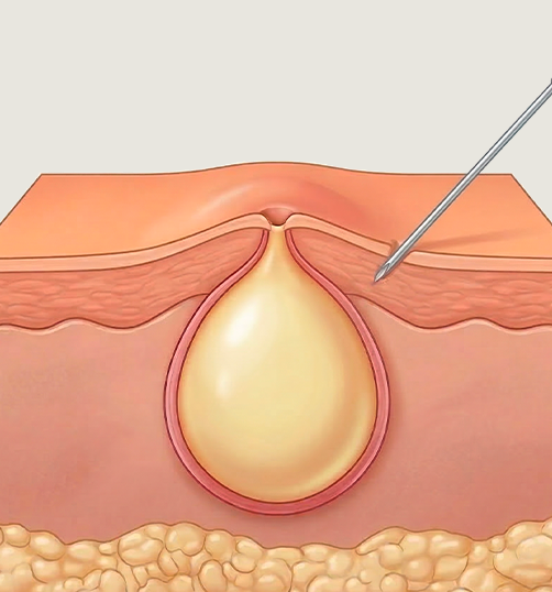 국소 마취