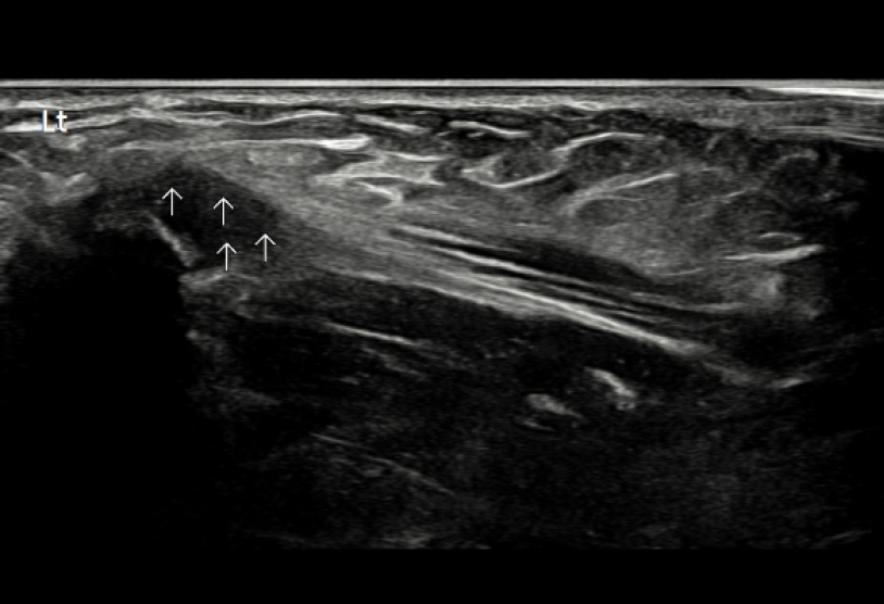 골프 엘보우 1단계 건염(Tendinitis) 초음파 사진