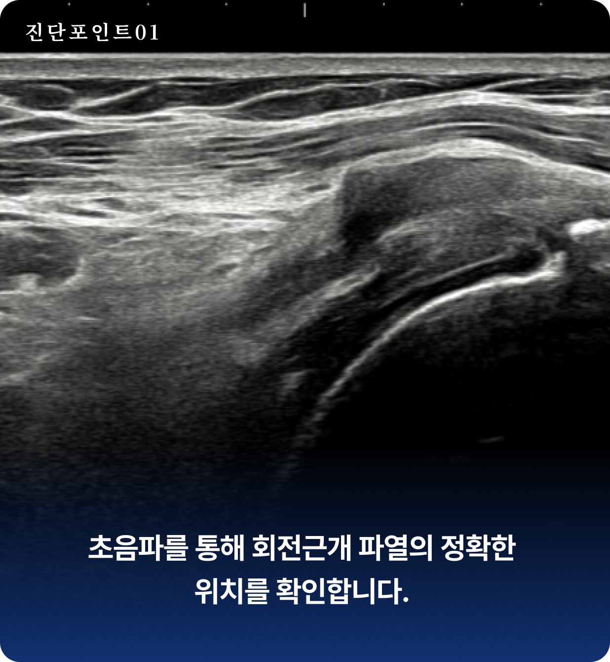 회전근개 파열 초음파 1