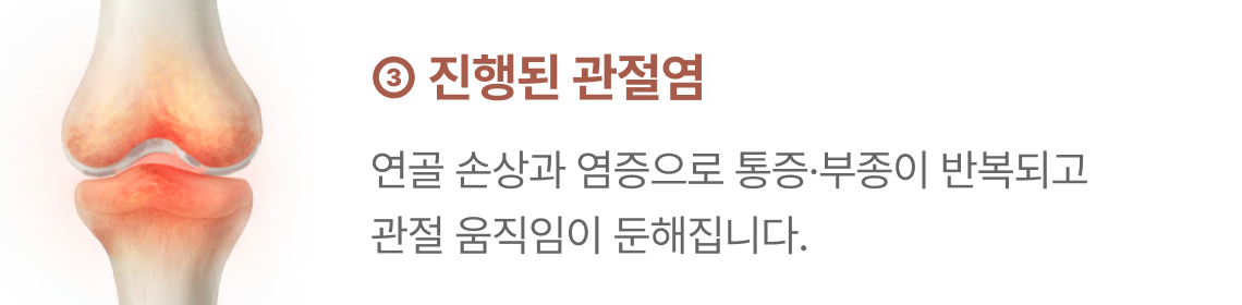 손가락 관절염 3단계 - 진행된 관절염