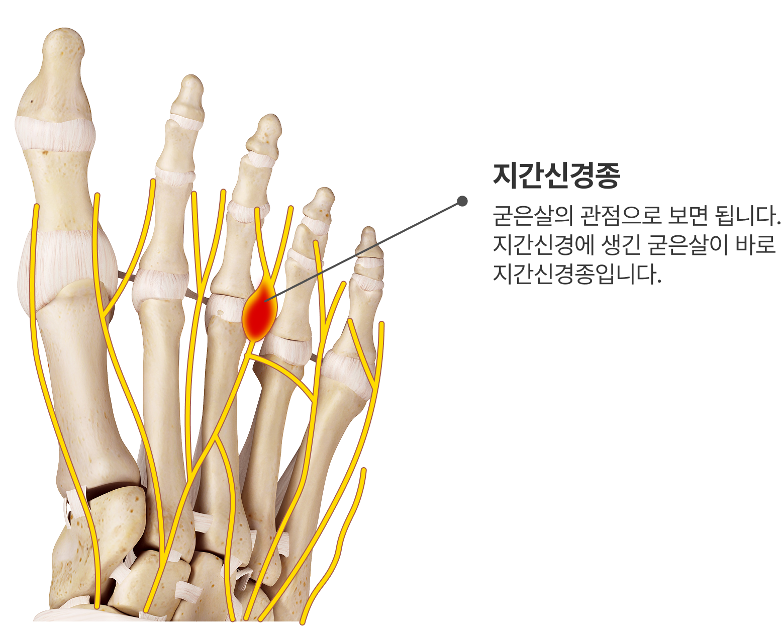 지간신경종 해부학 이미지