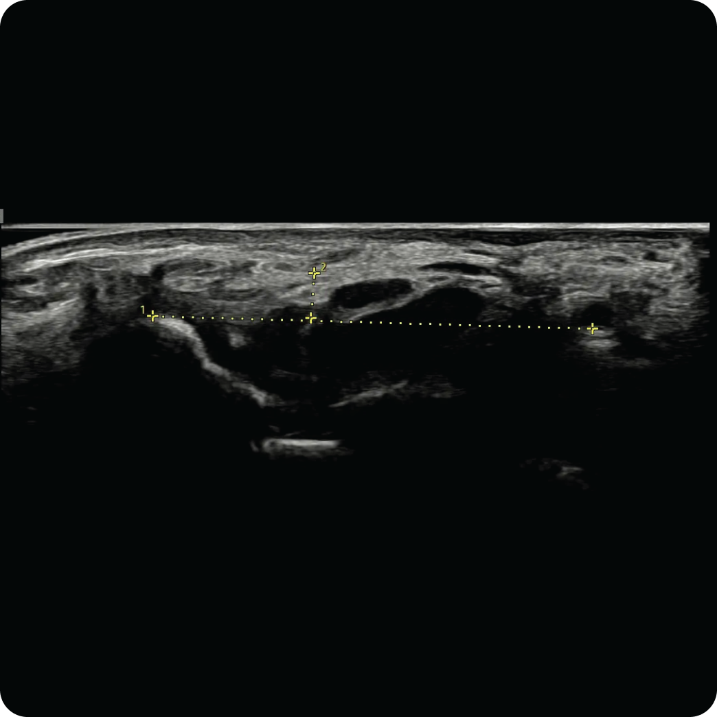 손목터널증후군 초음파 사진-횡수근인대(Flexor Retinaculum) 팽창 여부