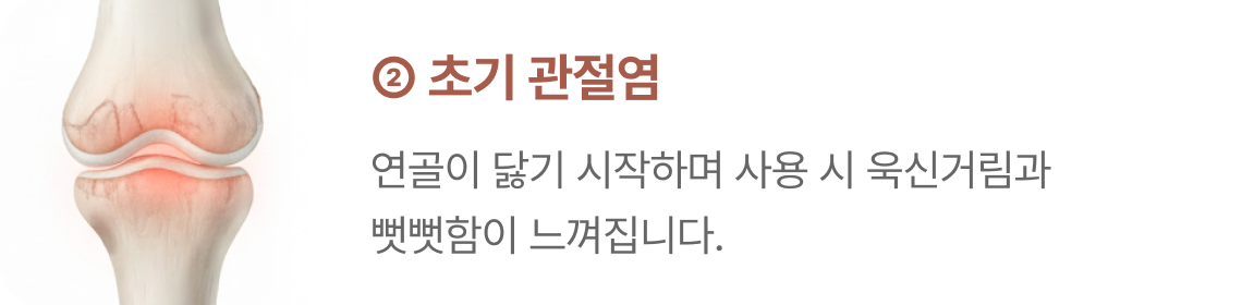 손가락 관절염 2단계 - 초기 관절염