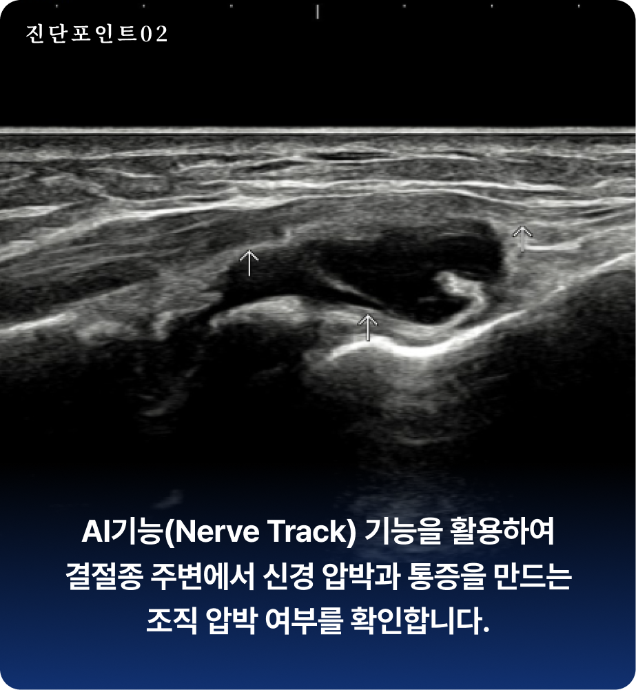 손목 결절종 진단 포인트 - AI기능(Nerve Track) 기능을 활용하여 결절종 주변에서 신경 압박과 통증을 만드는 조직 압박 여부를 확인합니다.