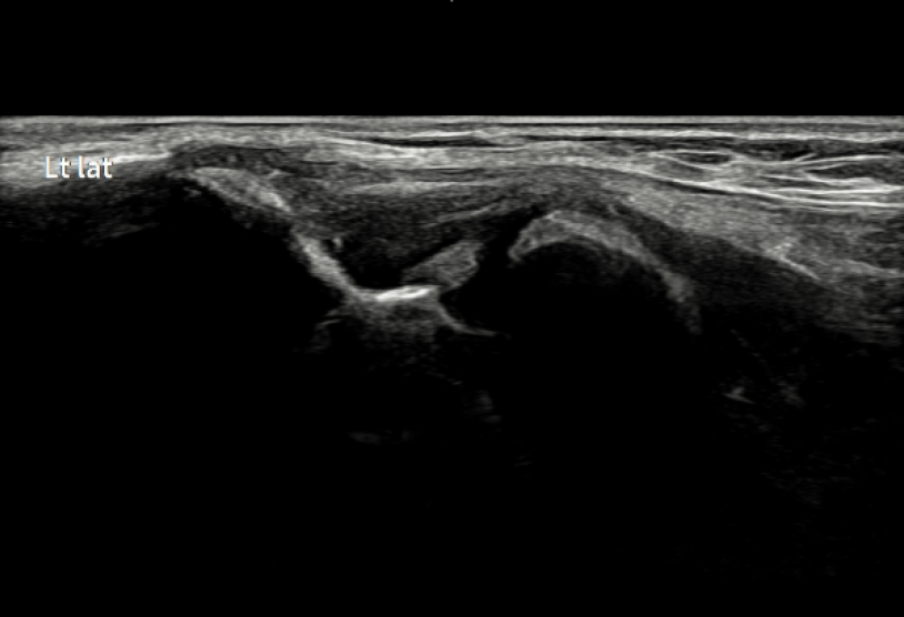 테니스엘보우 1단계 건염 (Tendinitis) 초음파 이미지