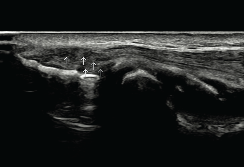 테니스엘보우 2단계 건증 (Tendinosis) 초음파 이미지