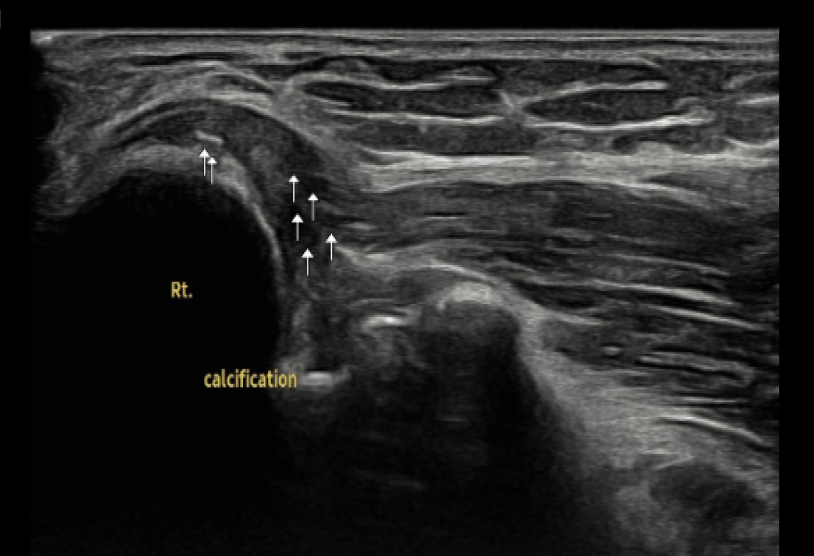 골프 엘보우 3단계 부분 파열(Partial Tear) 초음파 사진.