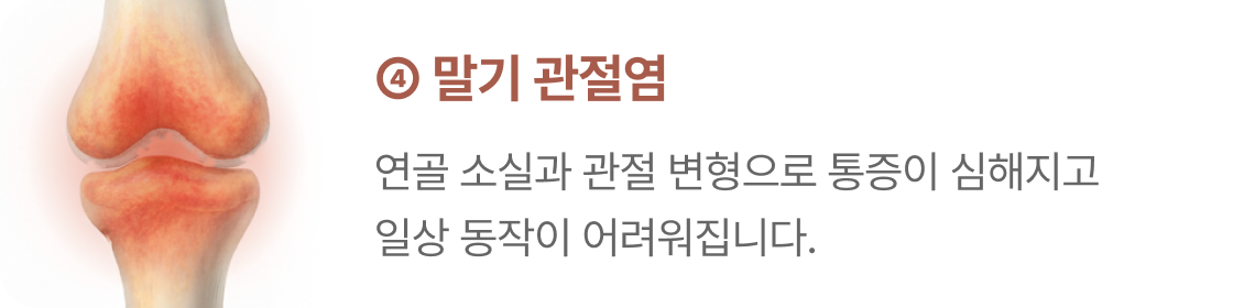 손가락 관절염 4단계 - 말기 관절염