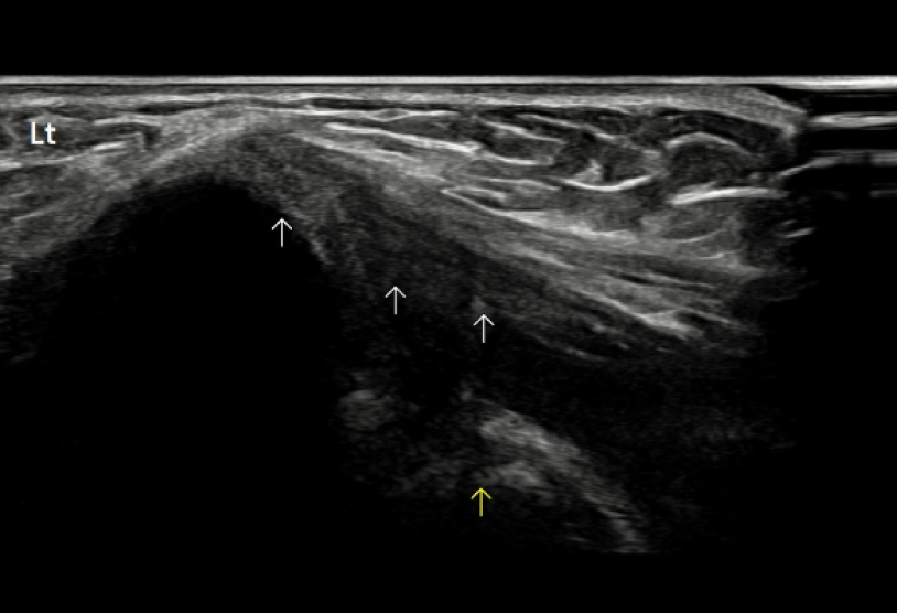 골프 엘보우 2단계 건증(Tendinosis) 초음파 사진