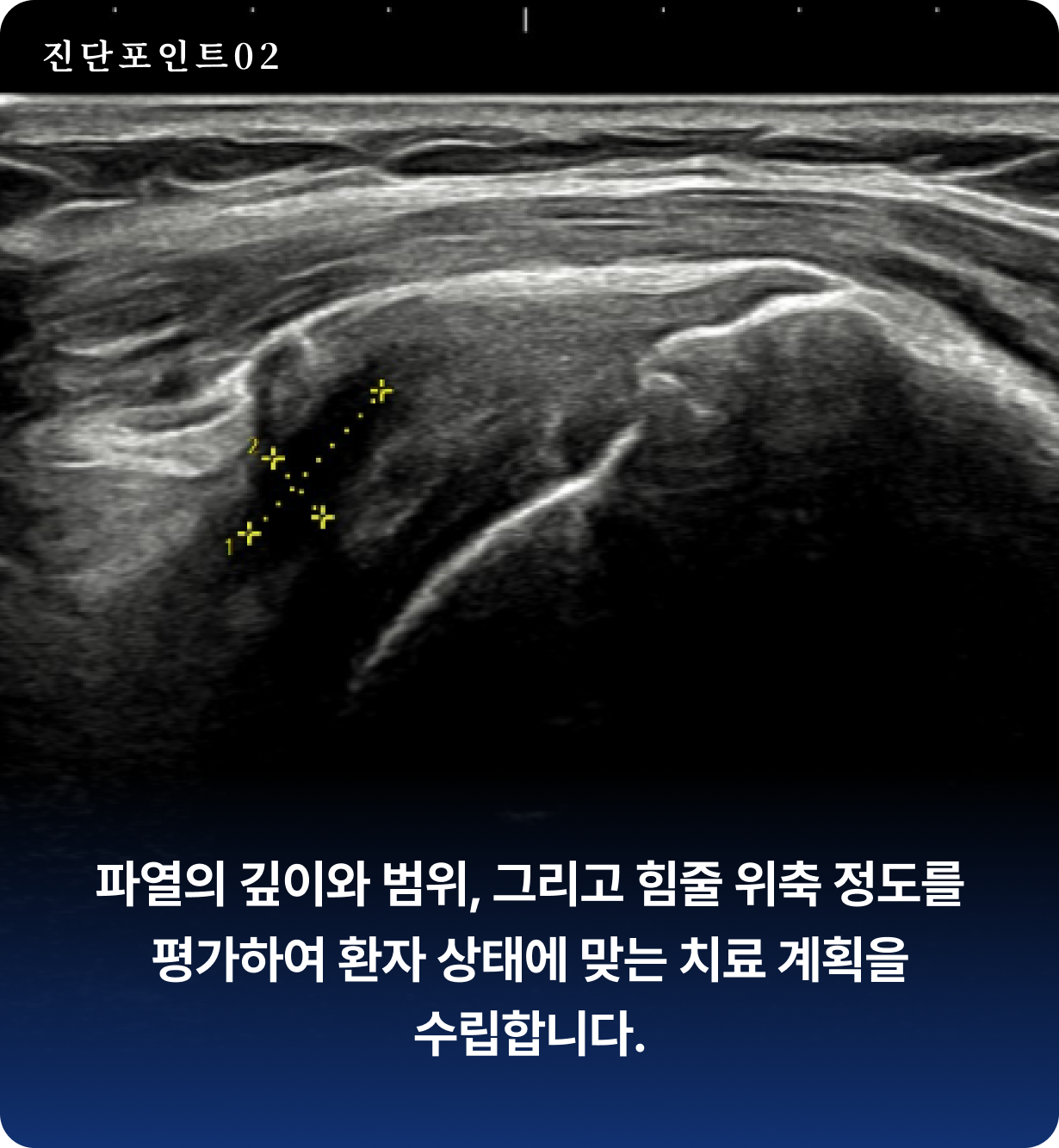 회전근개 파열 초음파 2