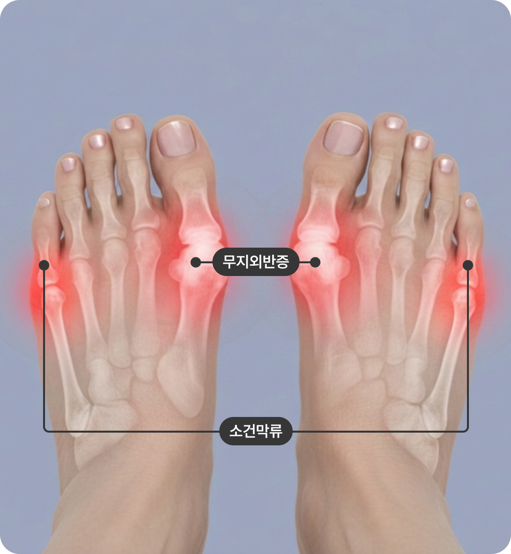 무지외반증/소건막류 질환 이미지