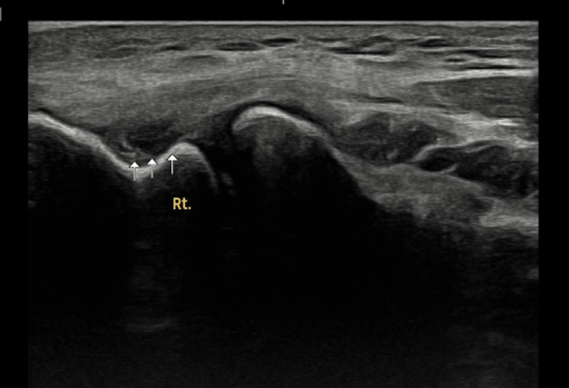 테니스엘보우 3단계 부분 파열(Partial Tear) 초음파 이미지