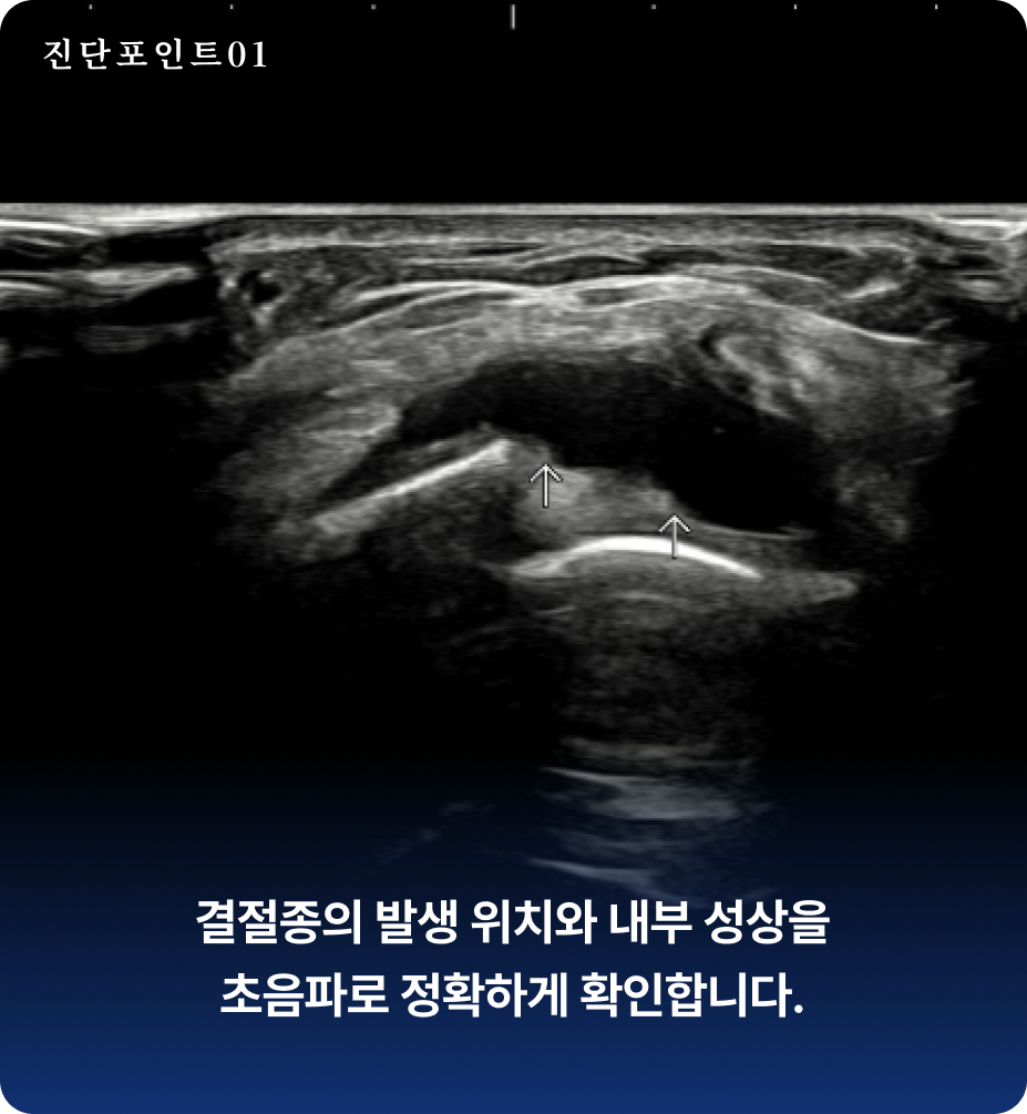 손목 결정종 진단 포인트 - 결절종의 발생 위치와 내부 성상을 초음파로 정확하게 확인합니다.