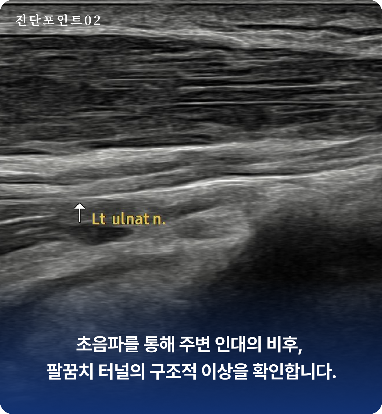 팔꿈치터널증후군 진단 포인트 2 - 초음파를 통해 주변 인대의 비후, 팔꿈치 터널의 구조적 이상을 확인합니다. 