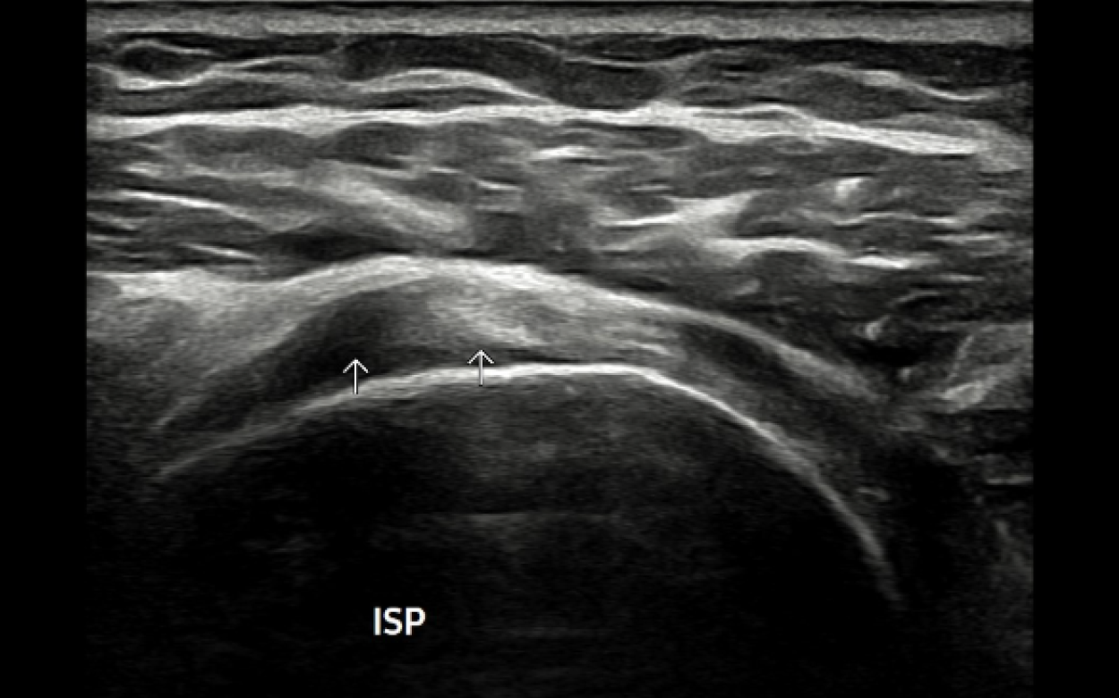 회전근개 염증 2단계 - 퇴행성 변화 단계 (건증, Tendinopathy) 초음파
