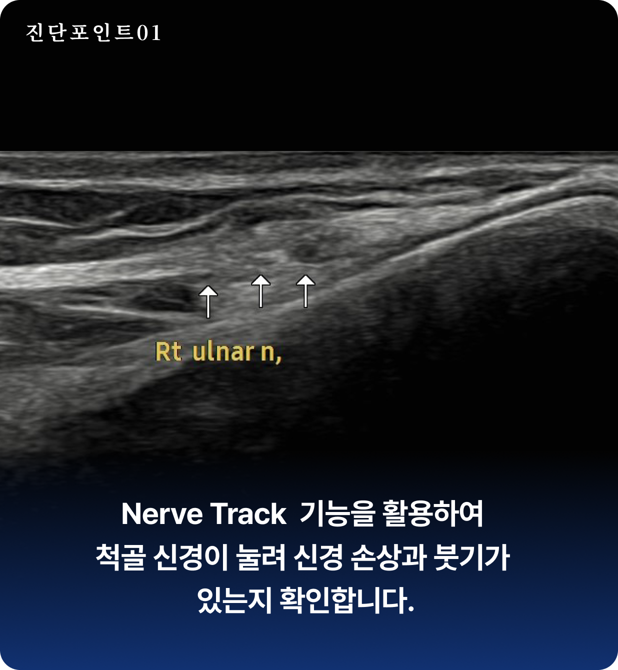 팔꿈치터널증후군 진단 포인트 1 - Nerve Track  기능을 활용하여  척골 신경이 눌려 신경 손상과 붓기가  있는지 확인합니다.