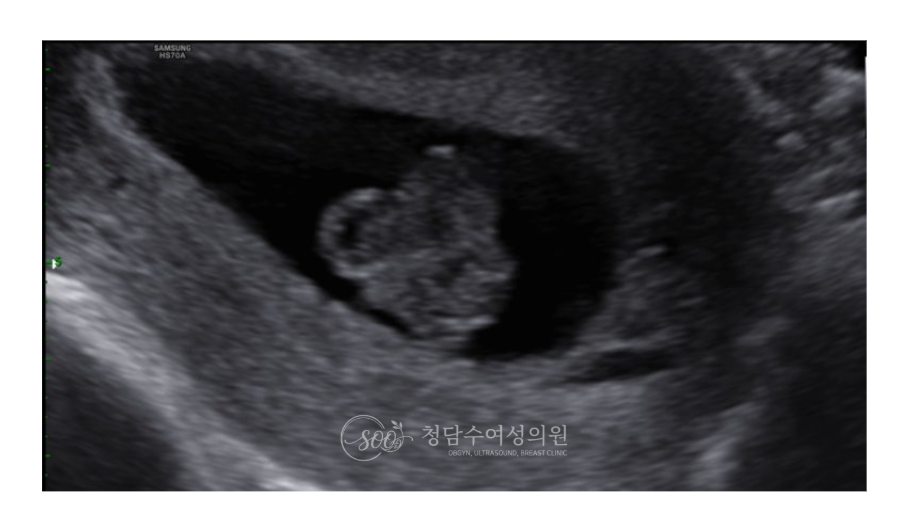 태아초음파