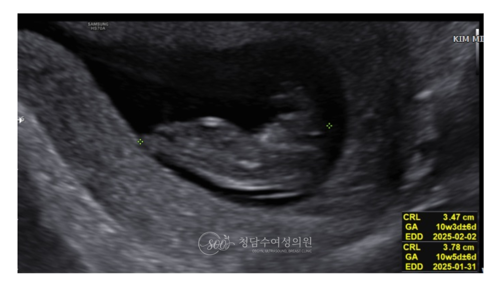 임신10주 초음파
