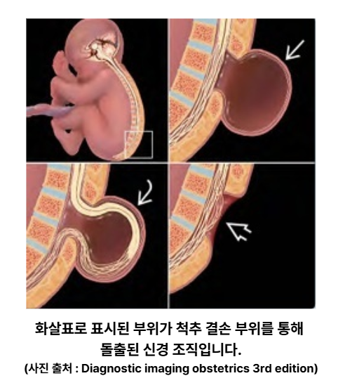 척추갈림증 그림