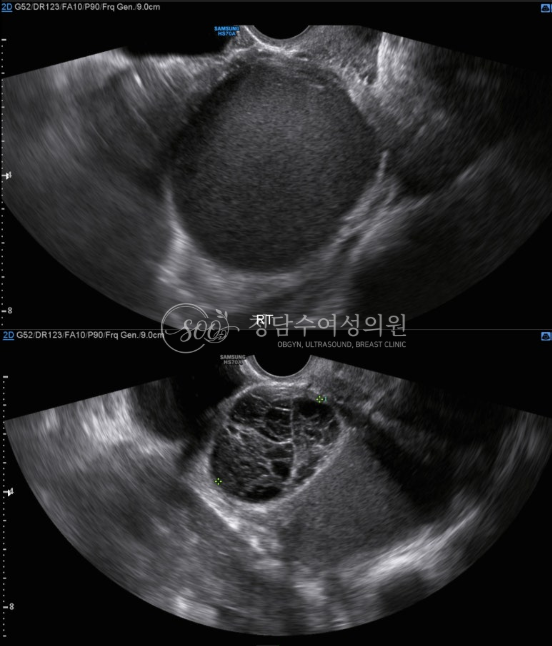 자궁내막증초음파